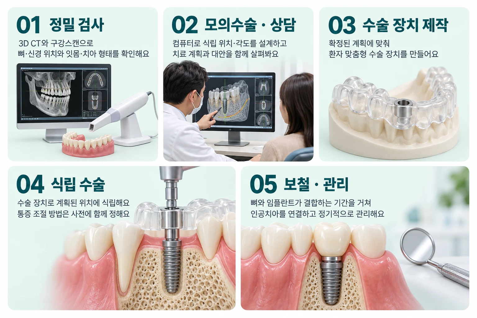 디지털 내비게이션 임플란트의 정밀 검사, 모의수술, 수술 가이드 제작, 식립, 보철·관리의 다섯 단계